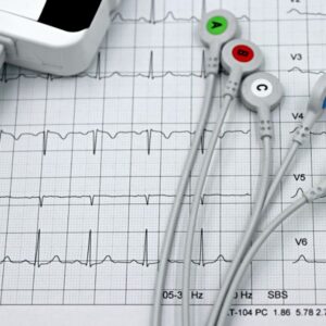 Mobile Electrocardiogram(EKG)